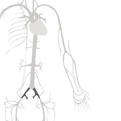 BeFlow stent for the treatment of iliac artery stenosis and thrombosis BeFlow stent for the treatment of iliac artery stenosis and thrombosis