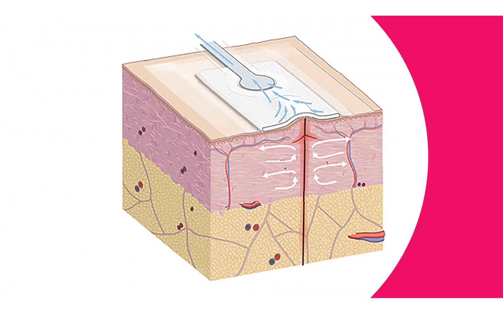 VAC therapy/negative pressure wound therapy (NPWT) for wound treatment: Why has it become popular and how to master it? 