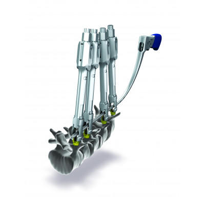 CD HORIZON LONGITUDE II Multi-level Percutaneous Fixation System